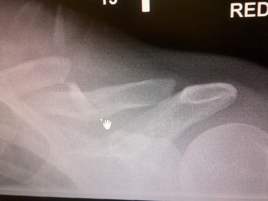 Broken collarbone recovery time?