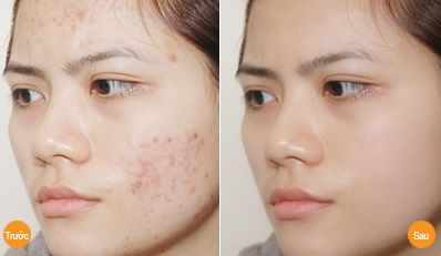 Không lo Mụn, mẩn ngứa , nóng trong , nóng gan với Cao Atiso Hà Giang - 3