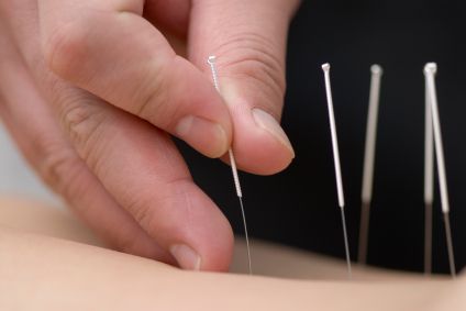 Acupuncture for alternative healthcare. photo AcupunctureToronto_zps6ab87b23.jpg